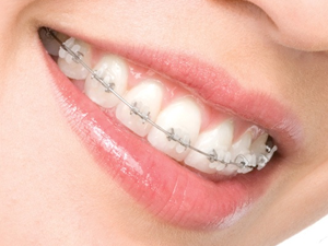 Aparelho Dentário Damon System em Inocoop - Aparelho Autoligável