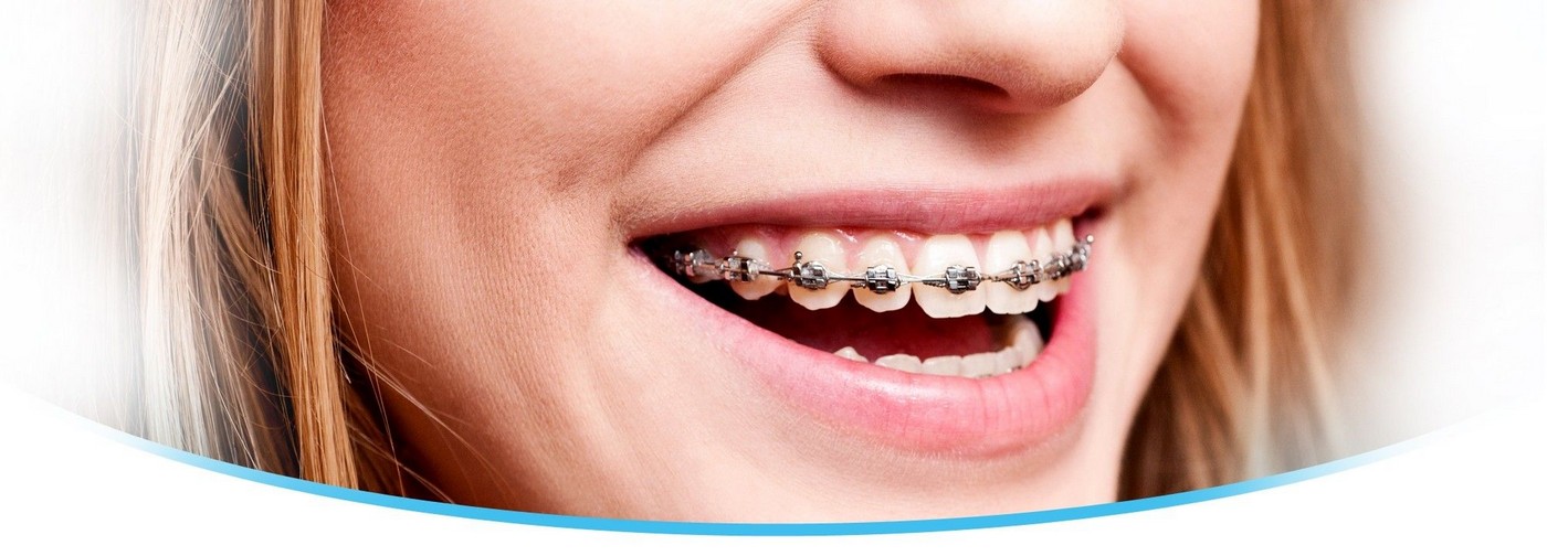 Aparelho Dentário Móvel na Vila Olga - Aparelhos de Rápido Tratamento