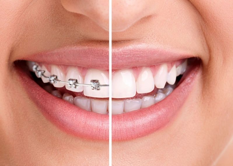 Aparelho Dentário Preço Embu-Mirim - Aparelhos de Rápido Tratamento