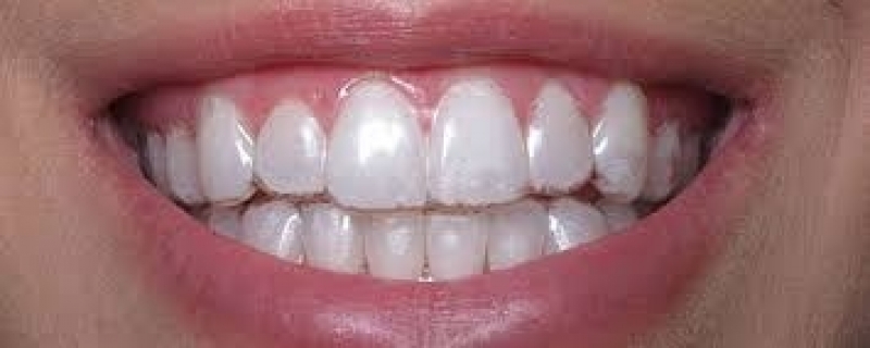 Aparelho Ortodôntico Invisalign Jardim Maria Sampaio - Aparelho Ortodôntico Invisalign