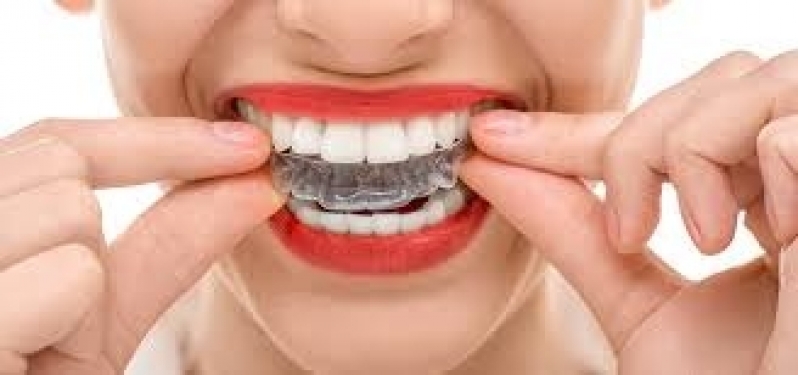 Aparelho Transparente Invisalign Jardim Maria Sampaio - Aparelho Dentário Transparente