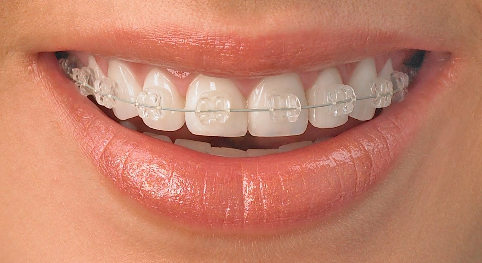 Aparelhos Dentários em Inocoop - Aparelhos Ortopédicos