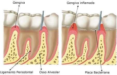 Cirurgia Periodontal Preço no Parque Regina - Dentista Especialista em Periodontia