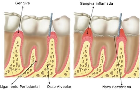 Cirurgia Periodontal Preço Embu-Mirim - Tratar Periodontite