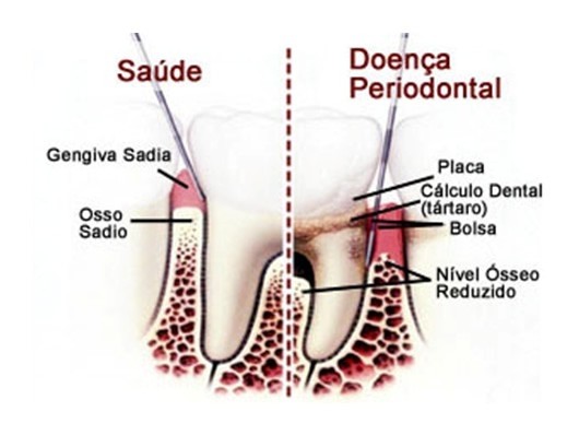 Cirurgia Periodontal Quanto Custa Vila Cercado Grande - Tratar Periodontite