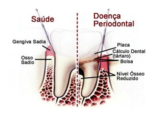 Cirurgia Periodontal na Vila Praia - Tratar Periodontite