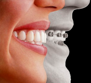 Clínica de Aparelhos Dentários Preço no Jardim Olinda - Aparelhos Invisíveis