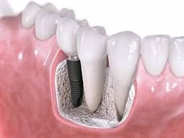 Clínica de Clínica Odontológica de Implante Dentário no Jardim Pinheiros - Implantes de Dentes