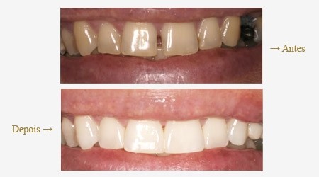 Clínica de Dentista Especialista em Estética na Vila América - Dentistas