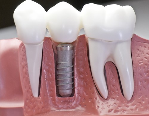 Clínica de Implantes Dentários em Sp Jardim Record - Consultório de Implantodontia