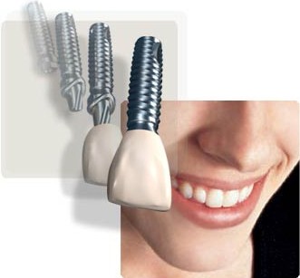 Clínica de Implantes Dentários Preço no Butantã - Consultório de Implantodontia