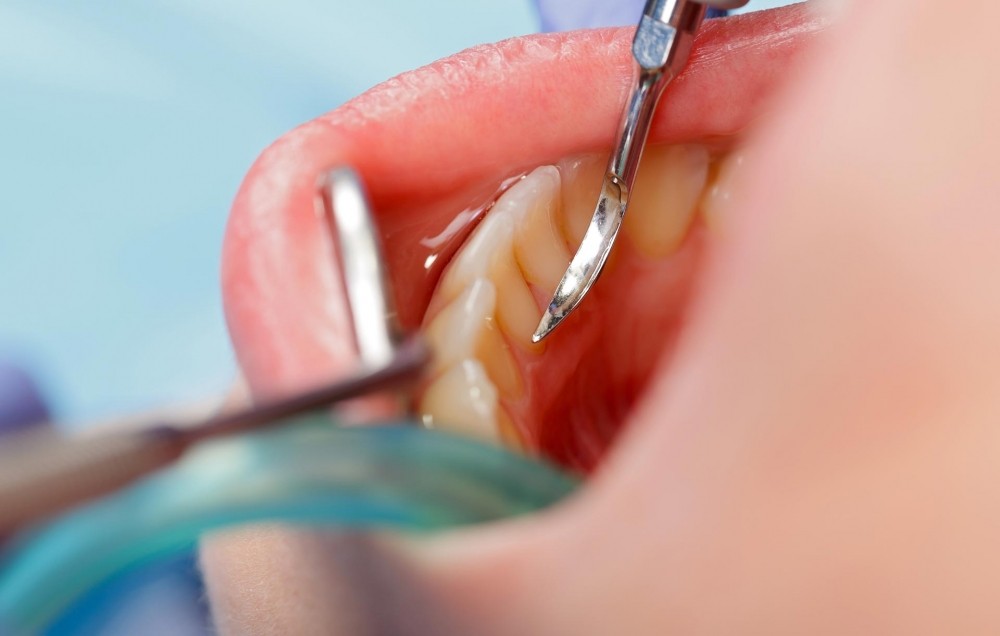 Clínica de Periodontia na Vila Pirajussara - Diagnóstico em Periodontia