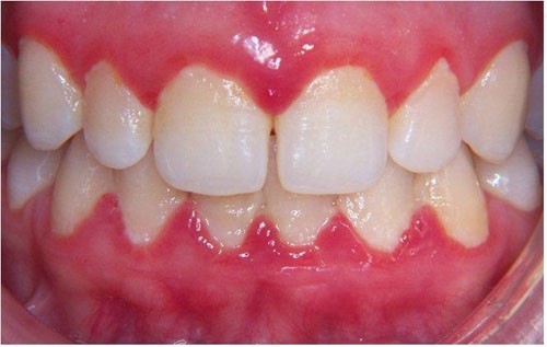 Clínica para Tratar Periodontia no Jardim Nadir - Dentista Periodontista