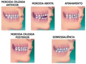 Colocação de Aparelho Dentário com Borrachinha na Vila Ferreirinha - Aparelhos Ortopédicos
