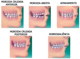 Colocação de Aparelho Dentário com Borrachinha em Inocoop - Aparelho Dentário em Taboão da Serra