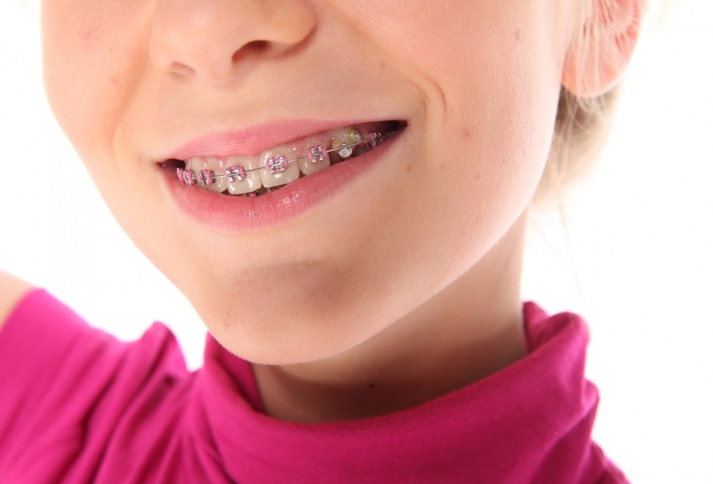 Colocação de Aparelho Dentário Fixo na Chácara do Bom Conselho - Aparelhos para Crianças