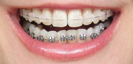 Colocação de Aparelho Dentário Móvel Vila Cercado Grande - Aparelho Dentário