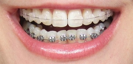 Colocação de Aparelho Dentário Móvel em Caxingui - Clínica de Aparelhos Dentários