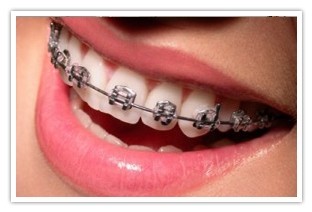 Colocação de Aparelhos Dentarios Fixos Transparentes no Jardim Bom Refúgio - Aparelhos de Rápido Tratamento