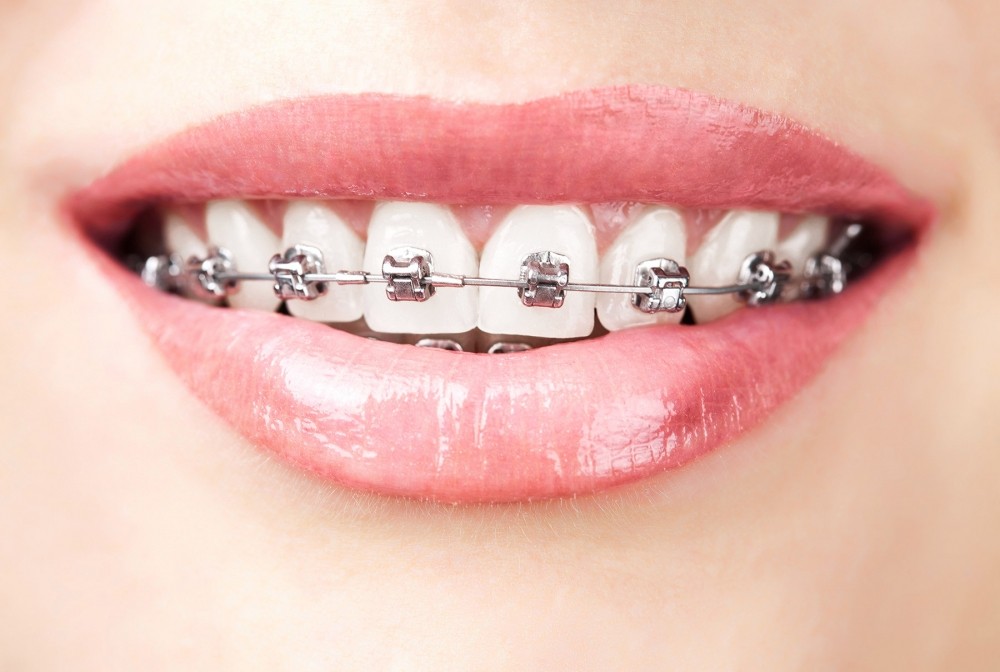 Colocação de Aparelhos Dentários Modernos no Jardim Tereza Rosa - Aparelho Dentário Damon System
