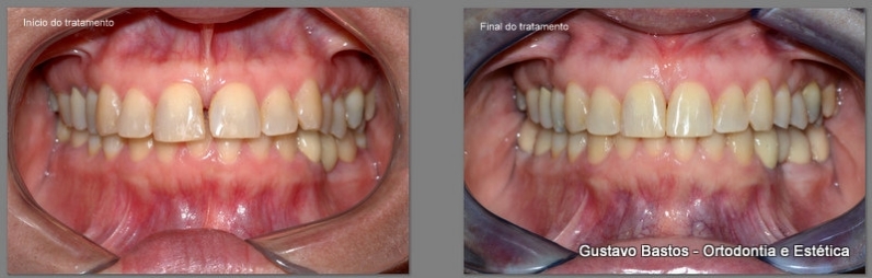 Colocar Aparelho Invisalign Vila Ferreirinha - Aparelho Dentário Invisível