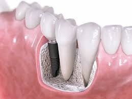 Consultório de Implantes Dentários Preço Embu Guaçu - Implantodontia
