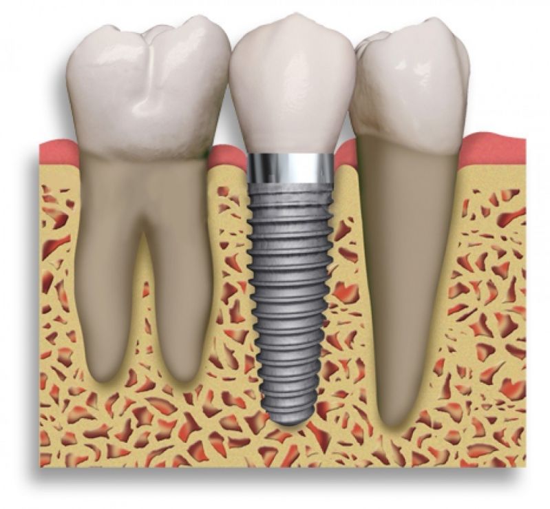 Consultório de Implantodontia no Jardim Maria Sampaio - Implantes Dentários em Sp