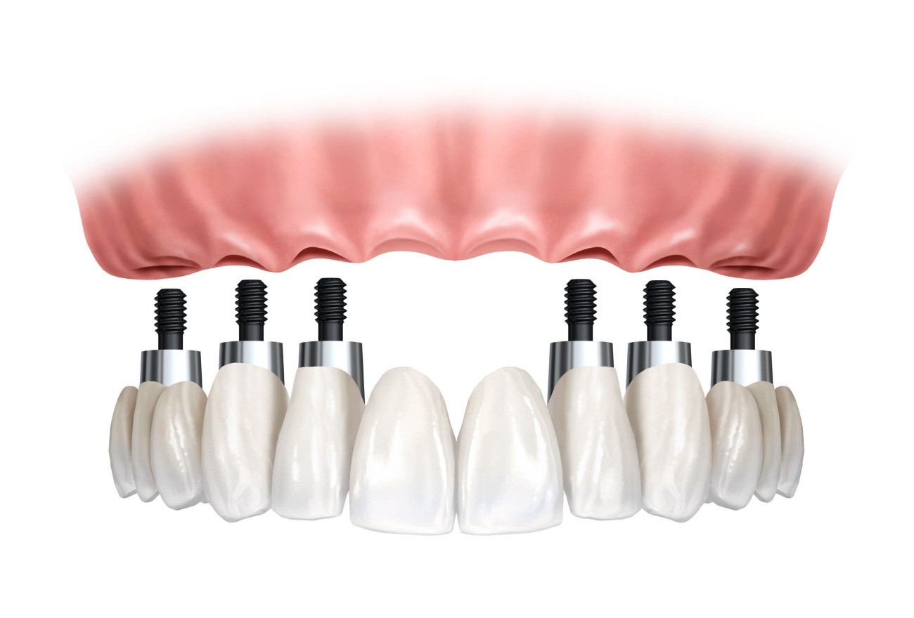 Consultório Odontológico de Implante Dentário no Conjunto Residencial Morumbi - Implantes de Dentes