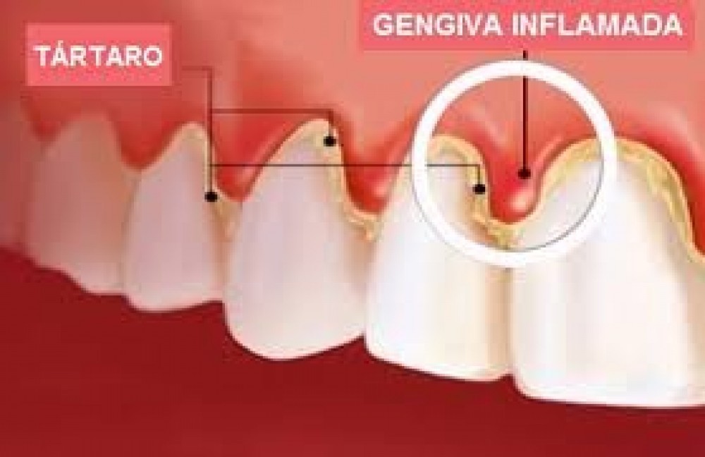 Dentista Especializado em Periodontia na Chácara do Bom Conselho - Dentista Periodontista