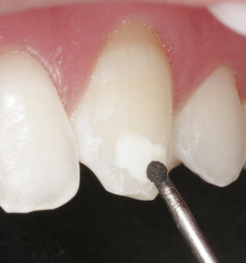 Dentista Especializado em Tratamento de Canal na Vila das Belezas - Dentista Especialista em Implante