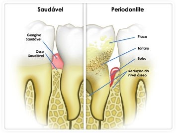 Dentista Periodontia em Inocoop - Cirurgia Periodontal