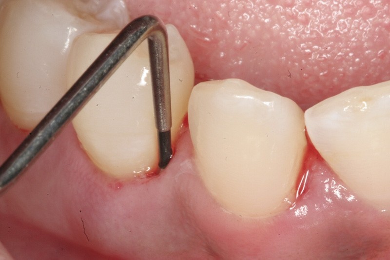 Diagnóstico Clinico em Periodontia no Jardim São Gilberto - Clínica de Periodontia