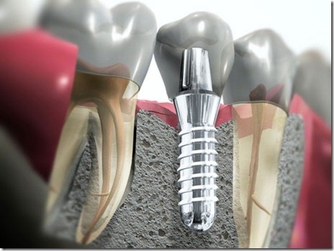 Implante Dental Quinhaú - Centro de Implantodontia