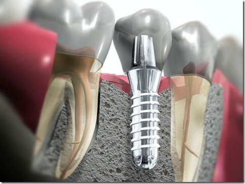 Implante Dental na Vila Brasil - Implantes de Dentes