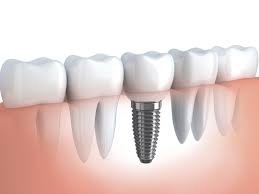 Implante Dentário em São Paulo no Jardim Paris - Implantodontia