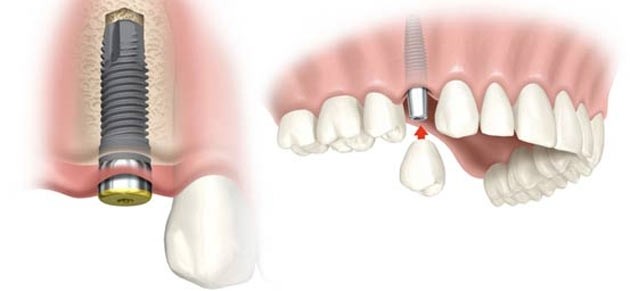 Implante Dentário Valor Aproximado no Jardim Taboão - Implante Dentário em Embu das Artes