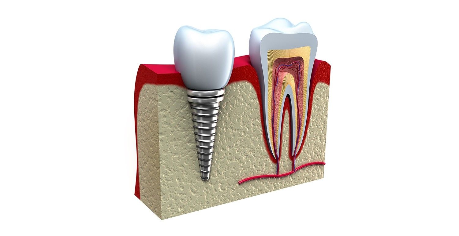 Implantes de Dentes Preço no Jardim Bom Refúgio - Implantes Dentários em Sp