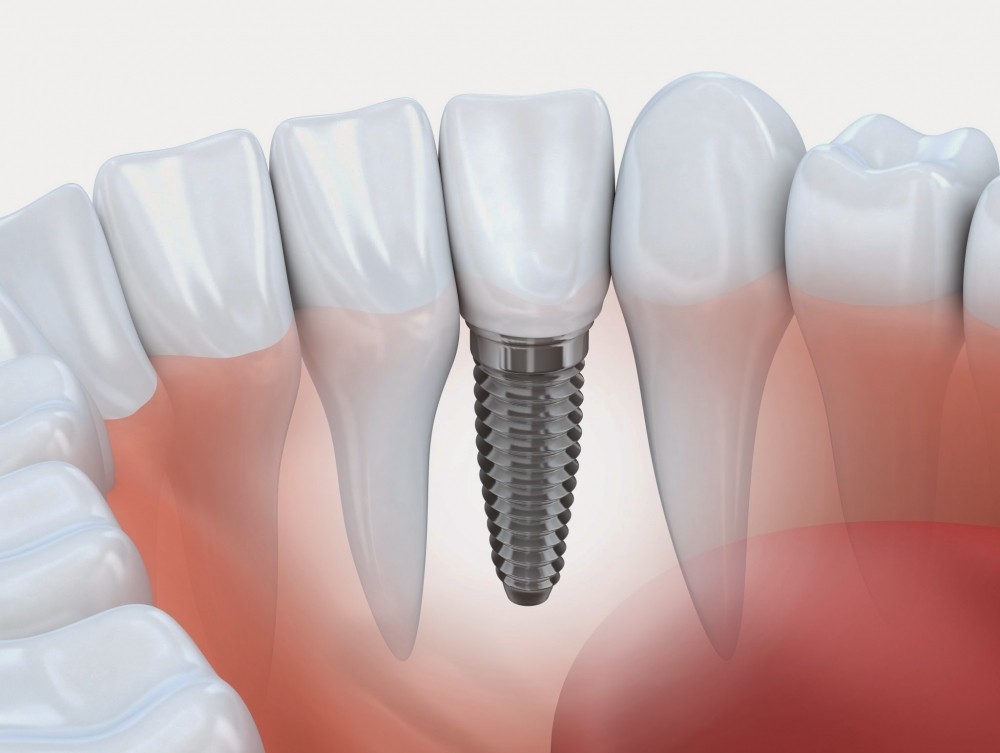 Implantes de Dentes Quanto Custa no Jardim Tereza Rosa - Clínica Odontológica de Implante Dentário