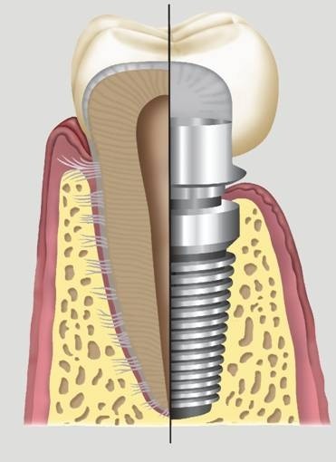 Implantes Dentários no Capelinha - Implantodontia