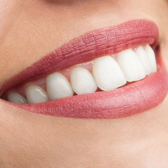 Lente de Contato para Dentes Tortos Chácara Pirajussara - Lente para Dentes