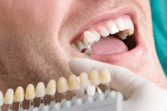 Lente de Contato para Dentes Jardim Record - Lente de Contato para Os Dentes