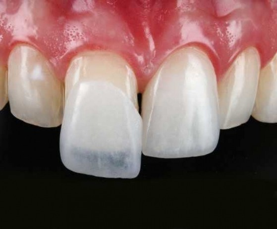 Lente de Contato para Os Dentes Jardim Nadir - Lente Dental