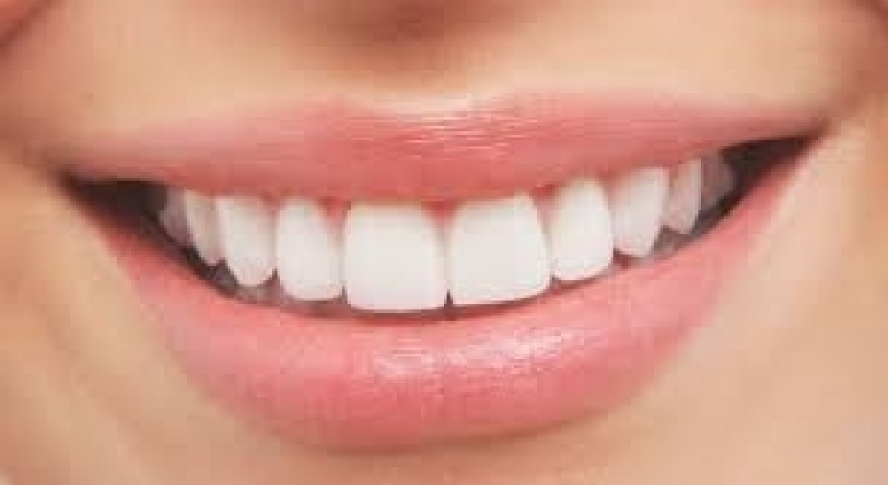 Lente para Dentes Jardim Samara - Lente Dental