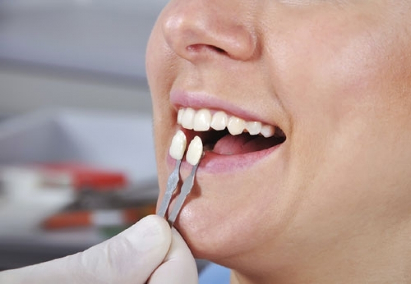 Lentes de Contato para Dentes Jardim Alexandrina - Lentes de Contato Dental