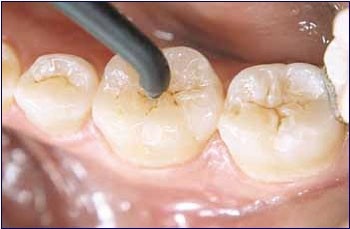 Limpeza Dentista Quanto Custa Vila Cercado Grande - Cirurgião Dentista
