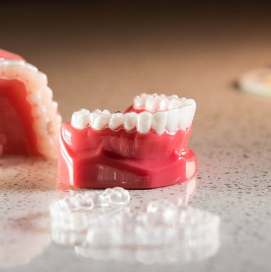 Onde Colocar Aparelho Invisalign Jardim Bom Refúgio - Aparelho Dentário Invisível