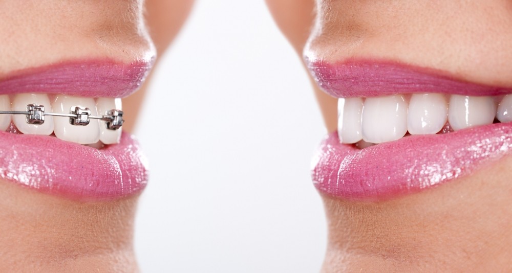 Onde Encontrar Aparelhos Ortopédicos no Conjunto Residencial Prestes Maia - Aparelho Dentário