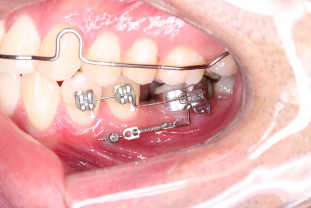Onde Encontrar Dentista Periodontista em Previdência - Clínica de Periodontia