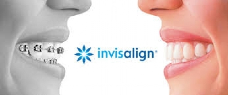 Onde Encontro Aparelho Autoligado Invisalign Jardim Samara - Invisalign Dentista