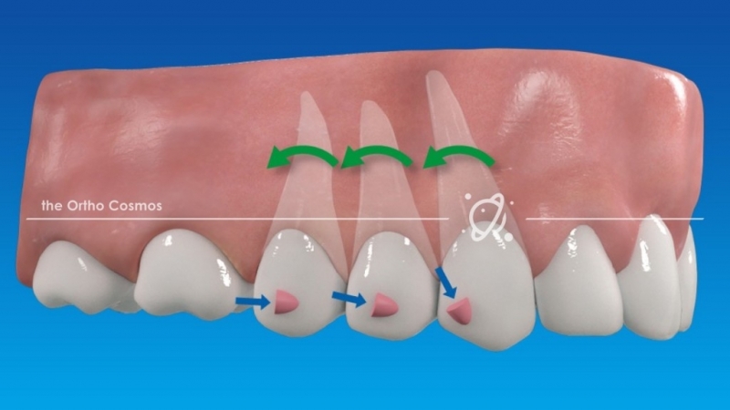 Onde Encontro Invisalign Dentista Cidade Universitária - Aparelho Dentário Transparente